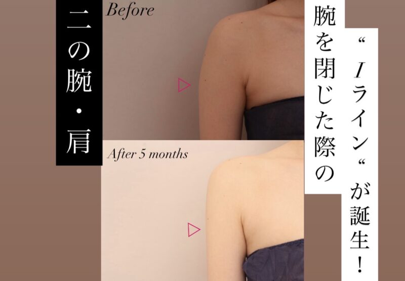 【究極のスレンダーライン】腕を閉じた時の「Iライン」が誕生！