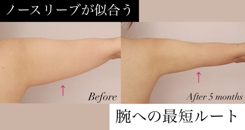 【もっと早くやればよかった！】ノースリーブが似合う腕への最短ルート