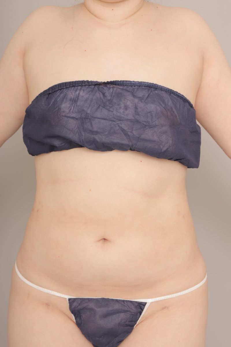 ベイザー脂肪吸引(6か月経過:38)の術前写真