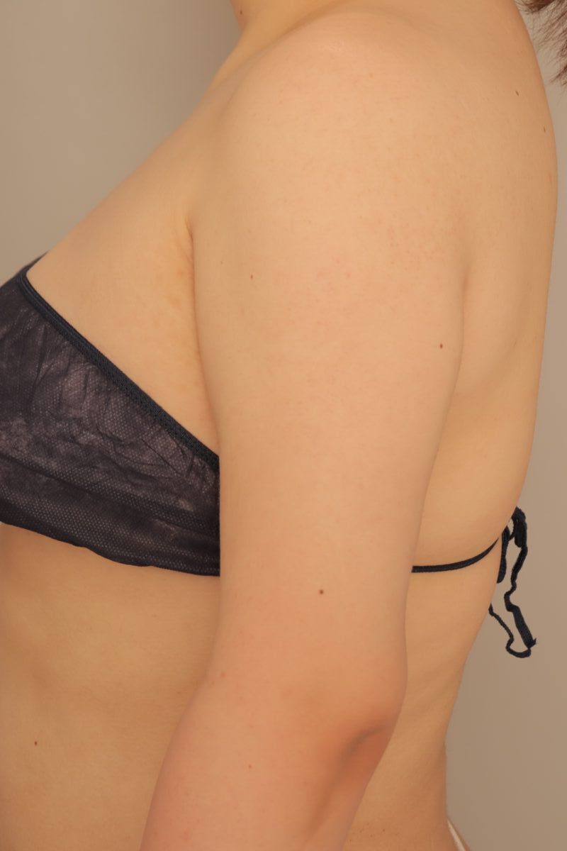 ベイザー脂肪吸引(半年経過:36)の術後写真