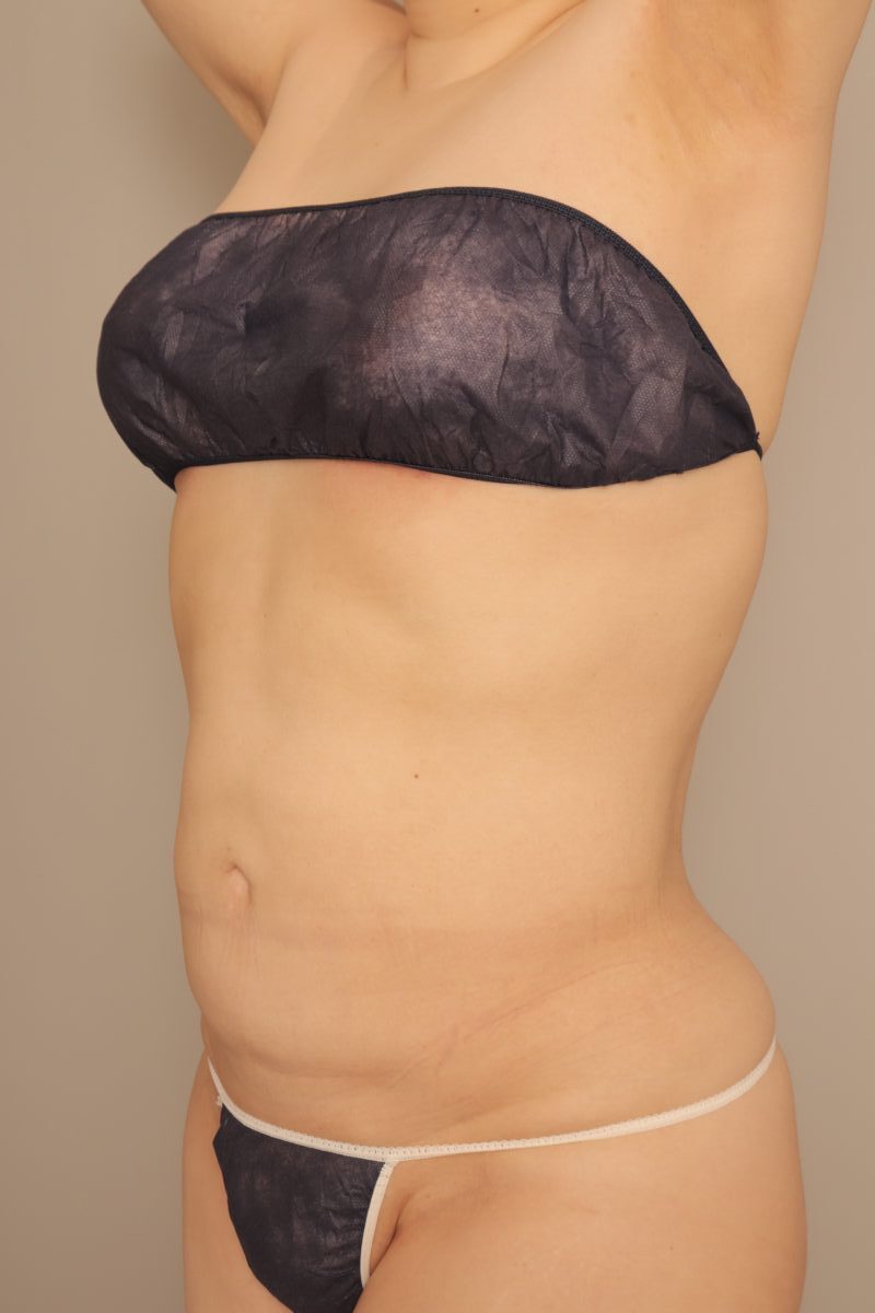 ベイザー脂肪吸引(半年経過:36)の術後写真