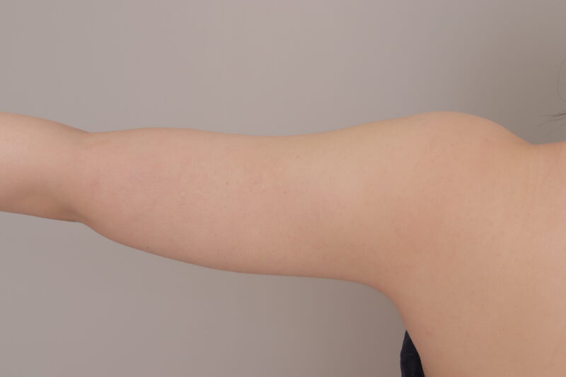 ベイザー脂肪吸引(1ヶ月経過:26)の術後写真