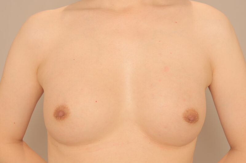 男性豊胸。実は男性の脂肪豊胸もできます。～39歳179cm69kg二次豊胸三か月後～