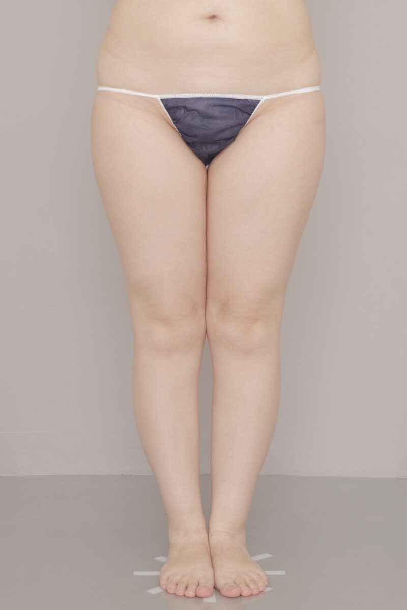 ベイザー脂肪吸引（４ヶ月経過：40）の術前写真