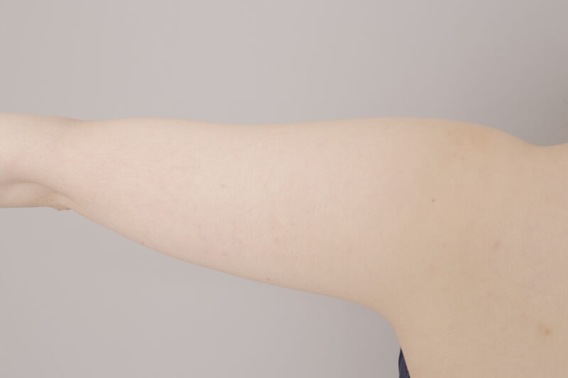 ベイザー脂肪吸引(3ヶ月経過:24)の術前写真