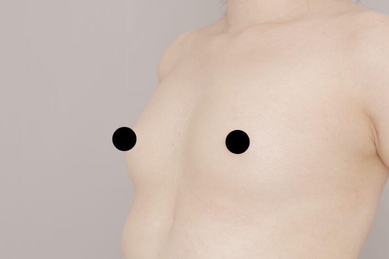 ベイザー脂肪吸引（3ヶ月経過：24）の術前写真