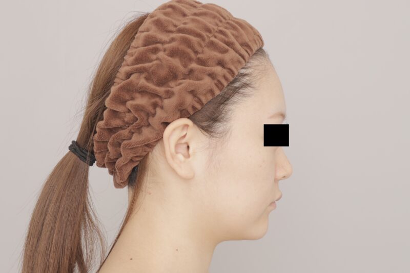 ベイザー脂肪吸引(3ヶ月経過:21)の術前写真