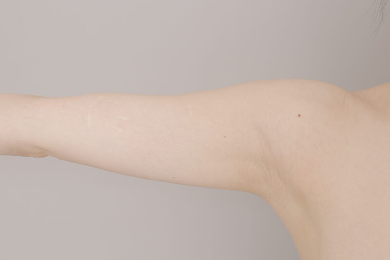 ベイザー脂肪吸引(6ヶ月経過:29)の術前写真