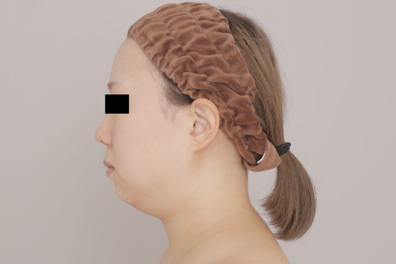 ベイザー脂肪吸引（3ヶ月経過：29）の術前写真