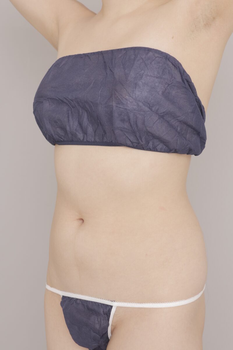 ベイザー脂肪吸引（1ヶ月経過：25）の術前写真