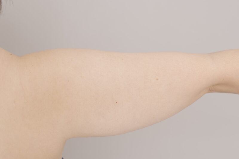 ベイザー脂肪吸引(1ヶ月経過:34)の術前写真