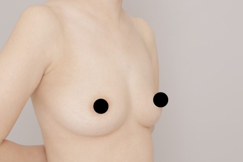 ベイザー脂肪吸引（1ヶ月経過：37）の術前写真