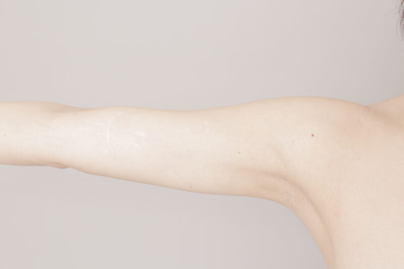 ベイザー脂肪吸引(6ヶ月経過:29)の術後写真