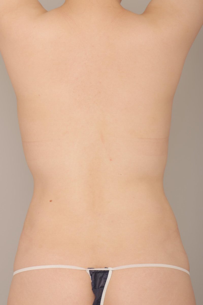 ベイザー脂肪吸引（6か月経過：25）の術前写真