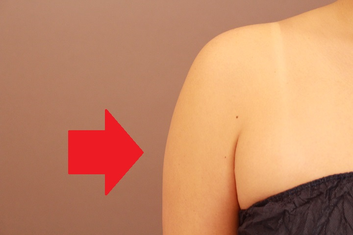 二の腕の脂肪吸引　まとめ