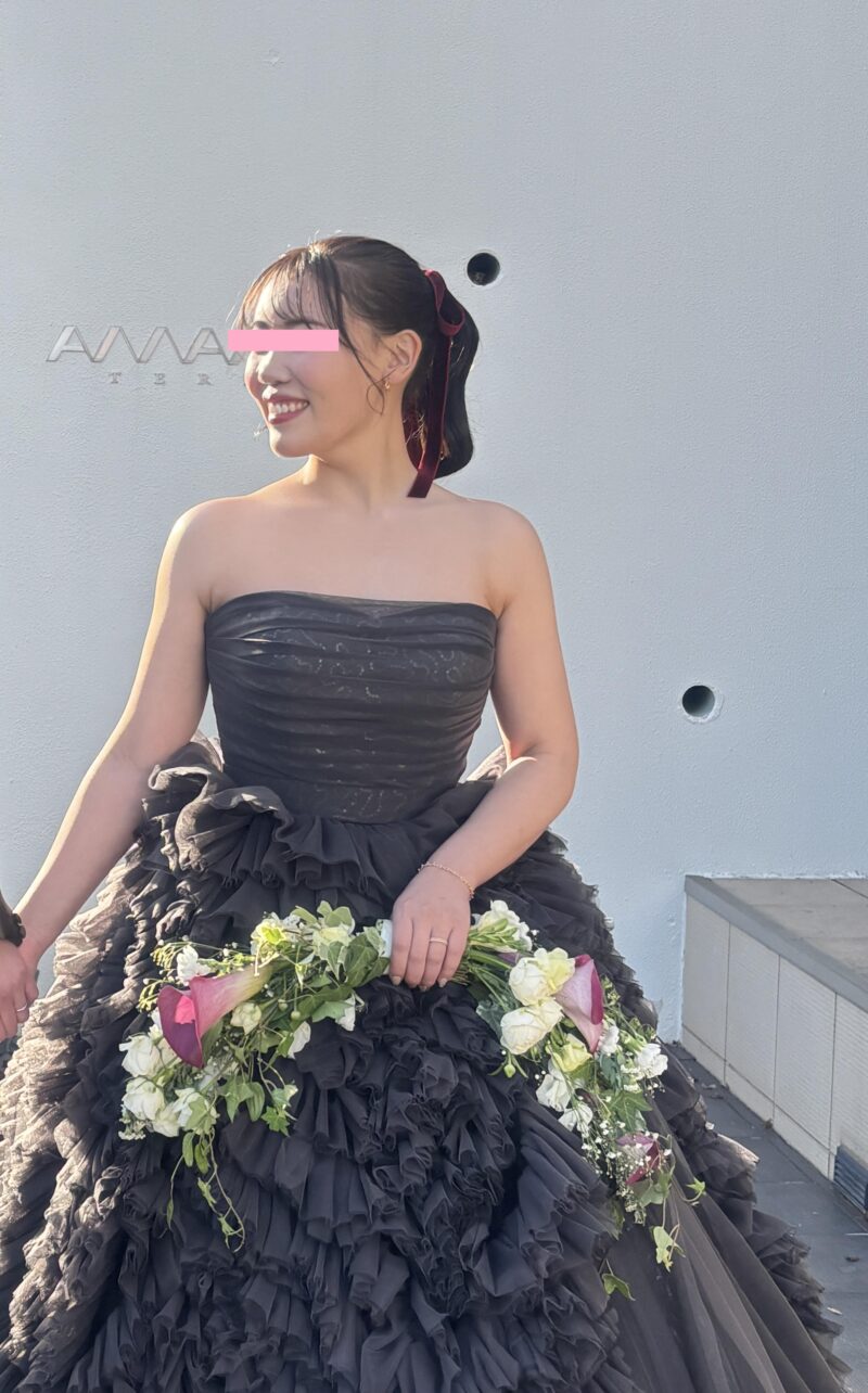 頬顎下脂肪吸引＋おでこ・こめかみ・頬コケ注入で晴れの日の写真も怖くない！　スタッフさんの経過をご紹介♪