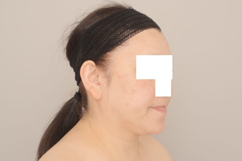 ベイザー脂肪吸引（3ヶ月経過：52）の術前写真