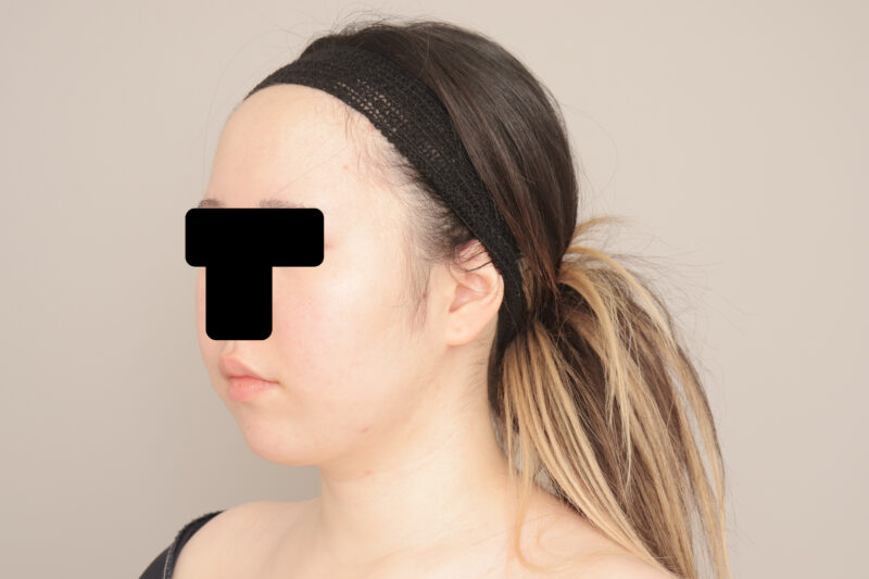 ベイザー脂肪吸引（１ヶ月経過：20）の術後写真