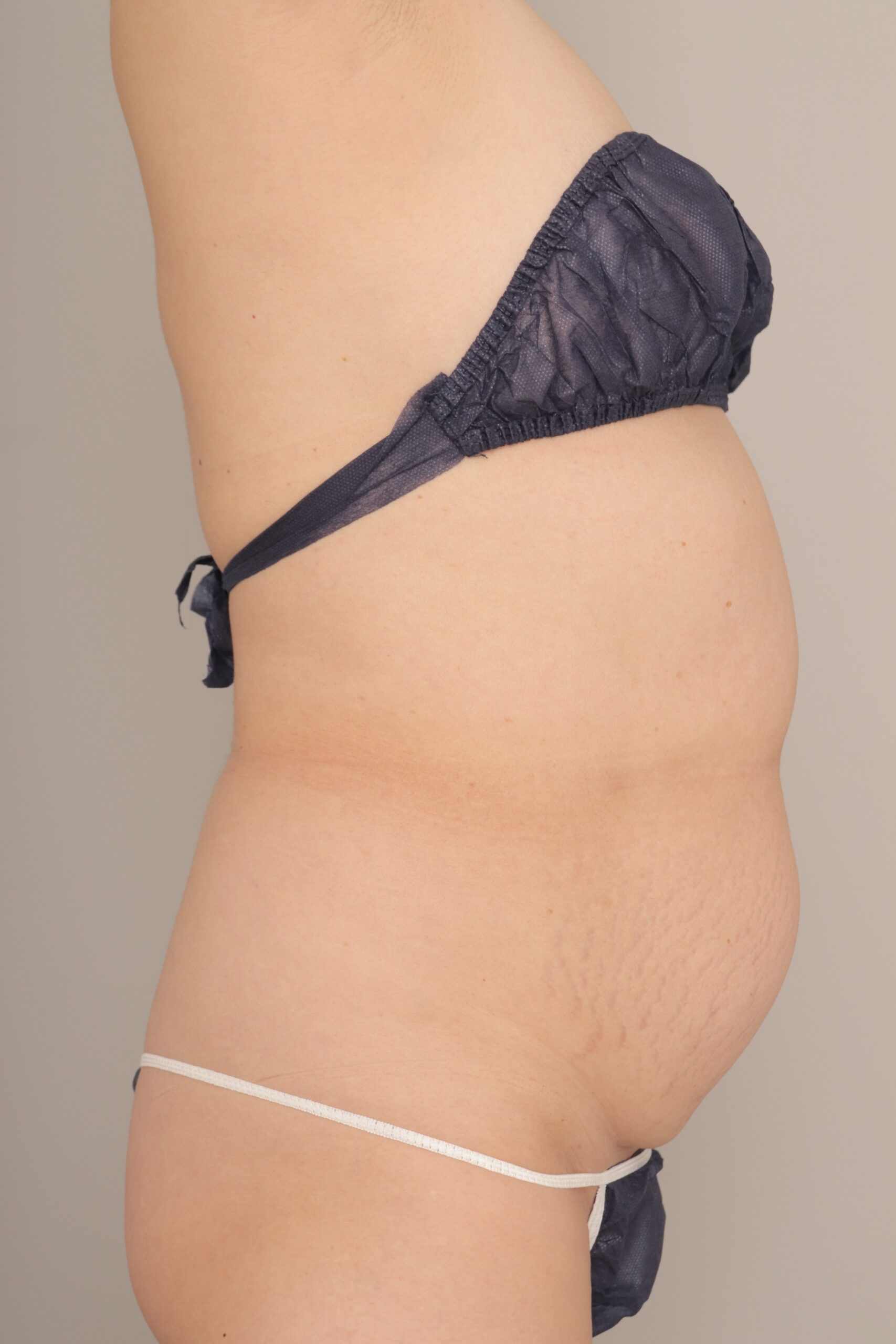 ベイザー脂肪吸引(6か月経過:57)の術前写真