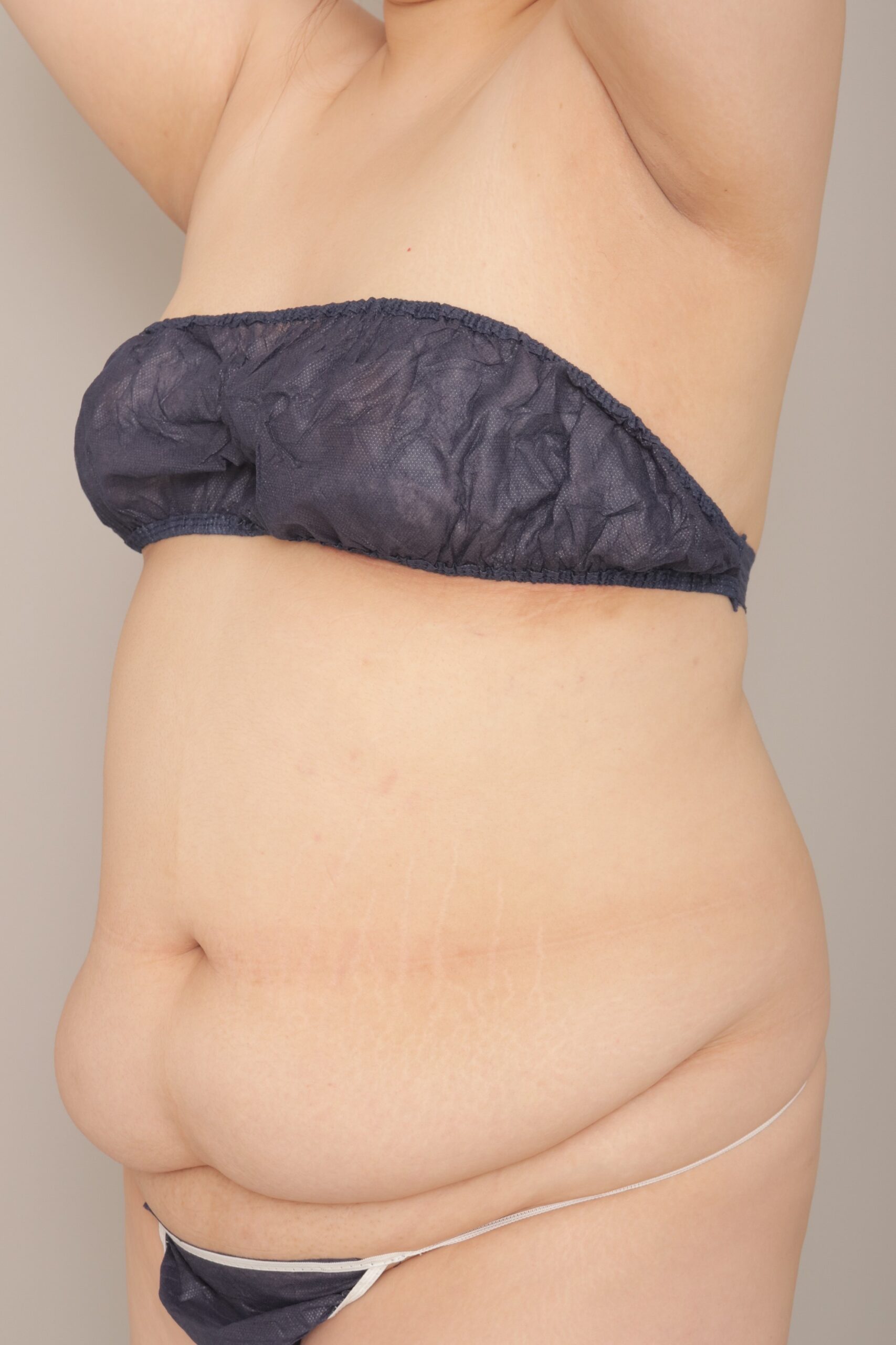 ベイザー脂肪吸引（４か月経過：22）の術前写真