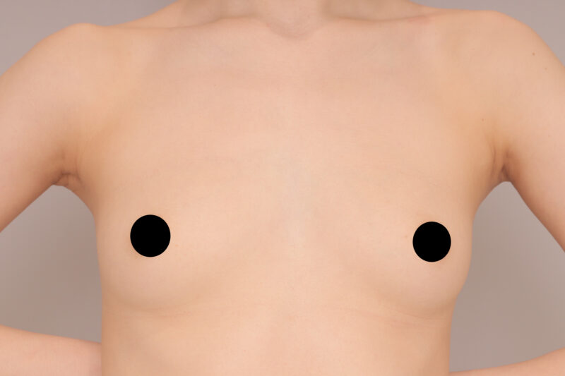 ベイザー脂肪吸引(1年後経過:21)の術前写真