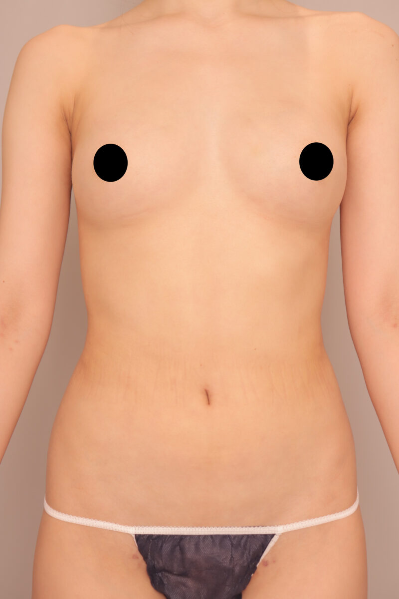 ベイザー脂肪吸引(1か月後経過:25)の術後写真