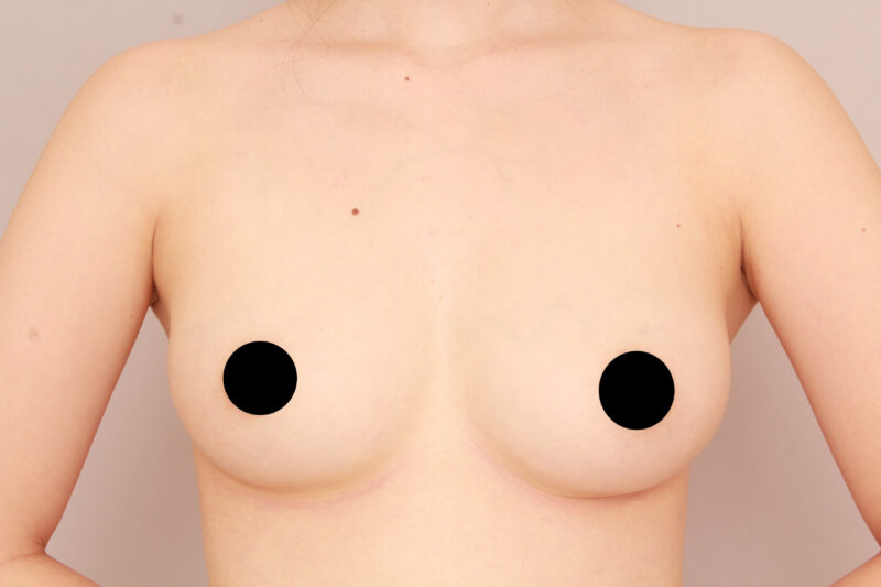 ベイザー脂肪吸引（５年後経過：28）の術前写真