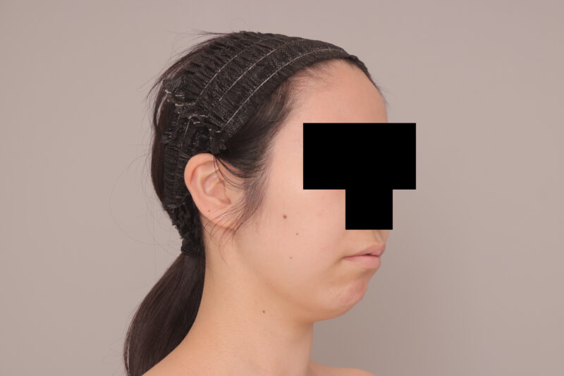 ベイザー脂肪吸引（3か月後経過：27）の術前写真