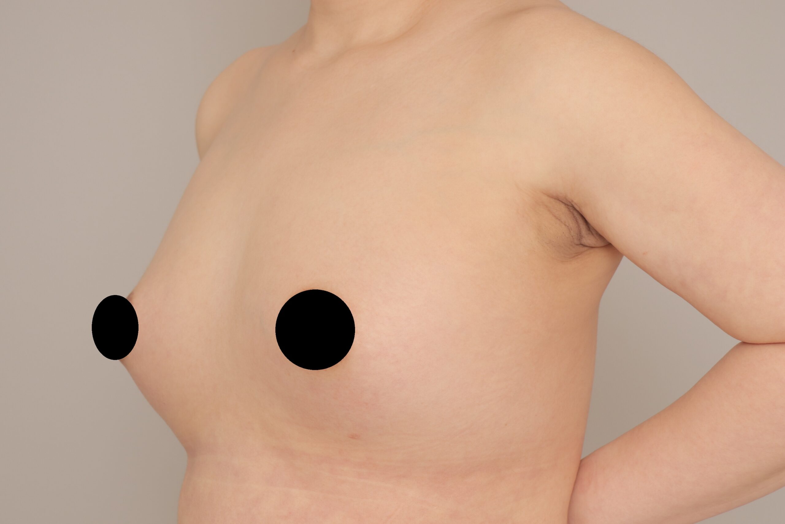 ベイザー脂肪吸引（6か月経過：38）の術後写真