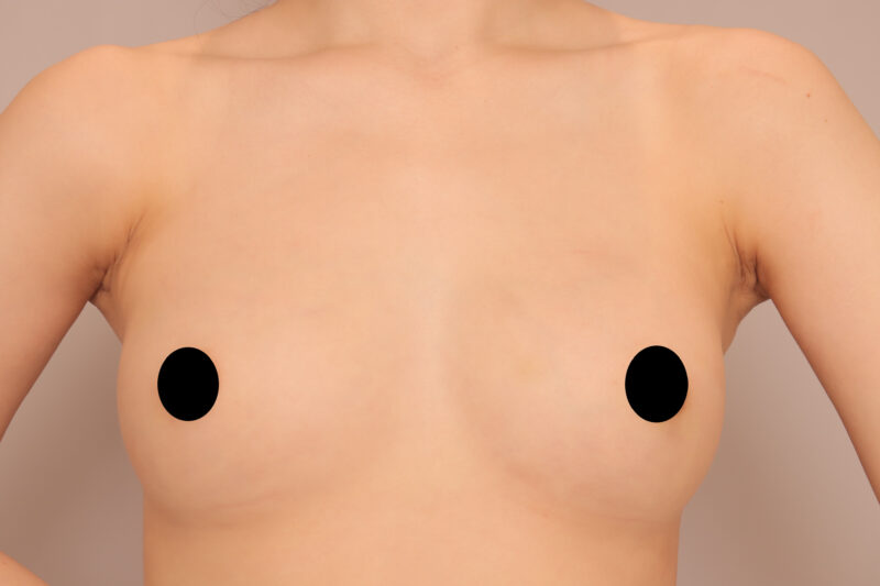 ベイザー脂肪吸引(1年後経過:21)の術後写真