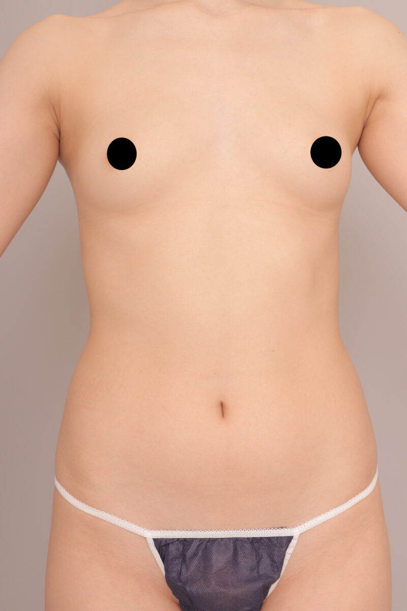 ベイザー脂肪吸引(1か月後経過:25)の術前写真