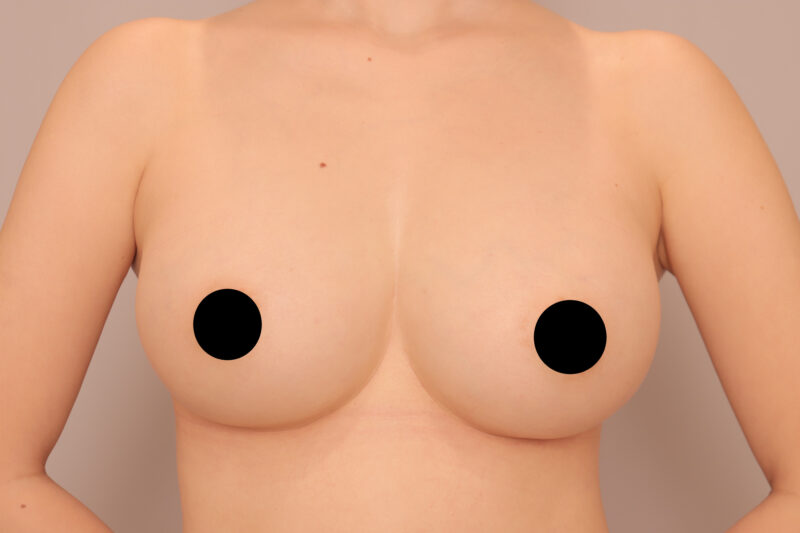 ベイザー脂肪吸引（５年後経過：28）の術後写真