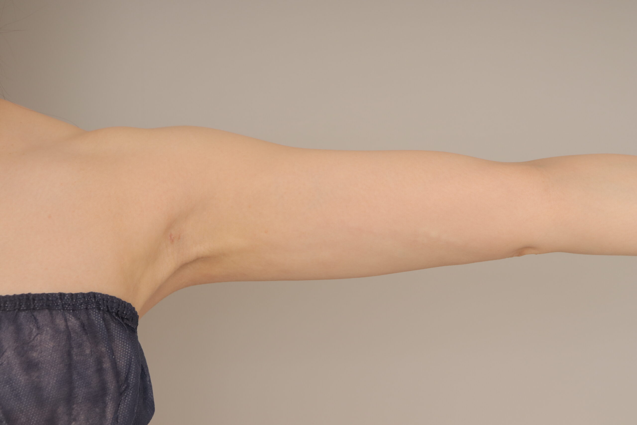 ベイザー脂肪吸引（1ヵ月経過：35）の術後写真