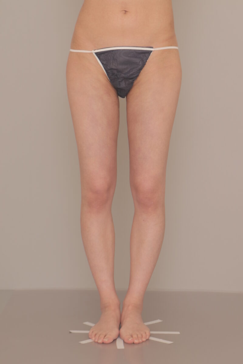 ベイザー脂肪吸引（1ヶ月経過：21）の術後写真