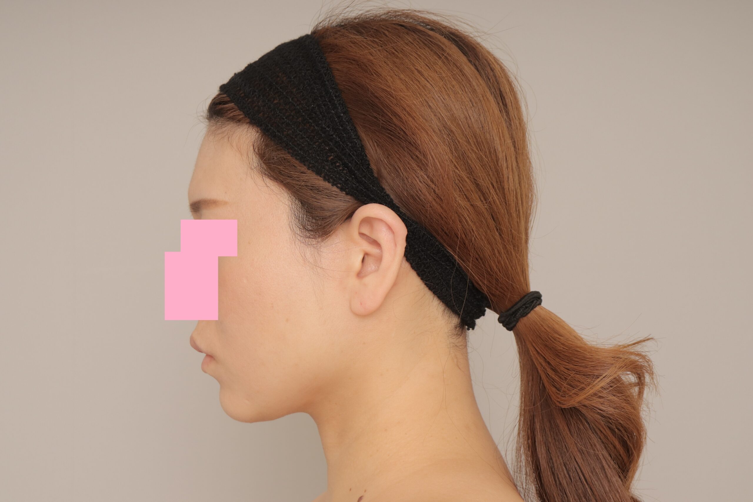 ベイザー脂肪吸引(1ヵ月経過:33)の術後写真