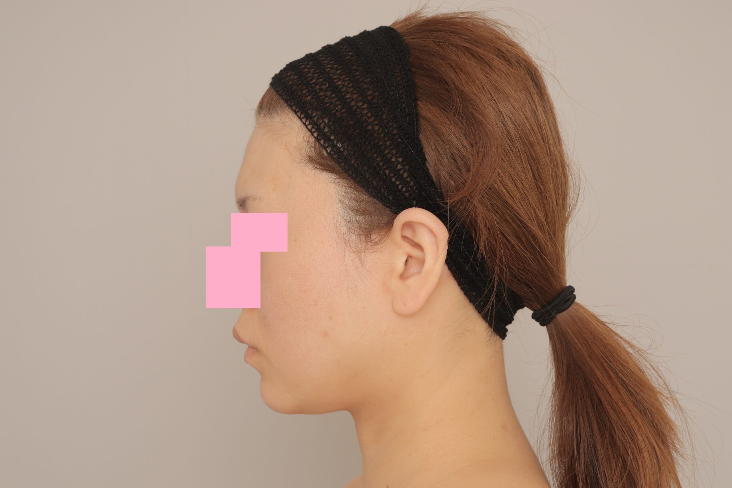 ベイザー脂肪吸引(1ヵ月経過:33)の術前写真