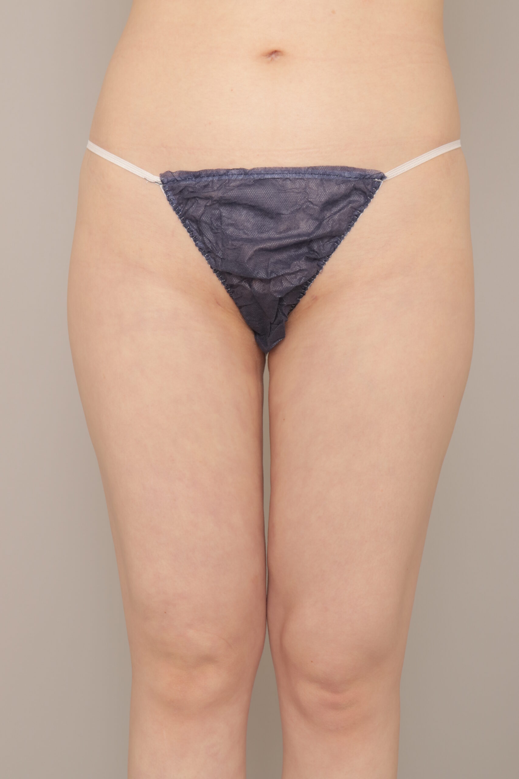 ベイザー脂肪吸引（1ヵ月経過：26）の術後写真