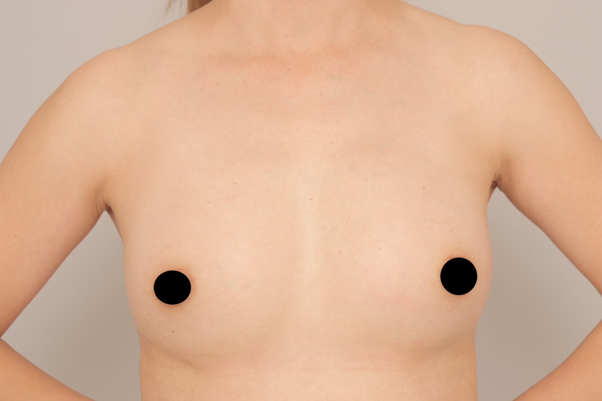 ベイザー脂肪吸引（1か月経過：43）の術後写真