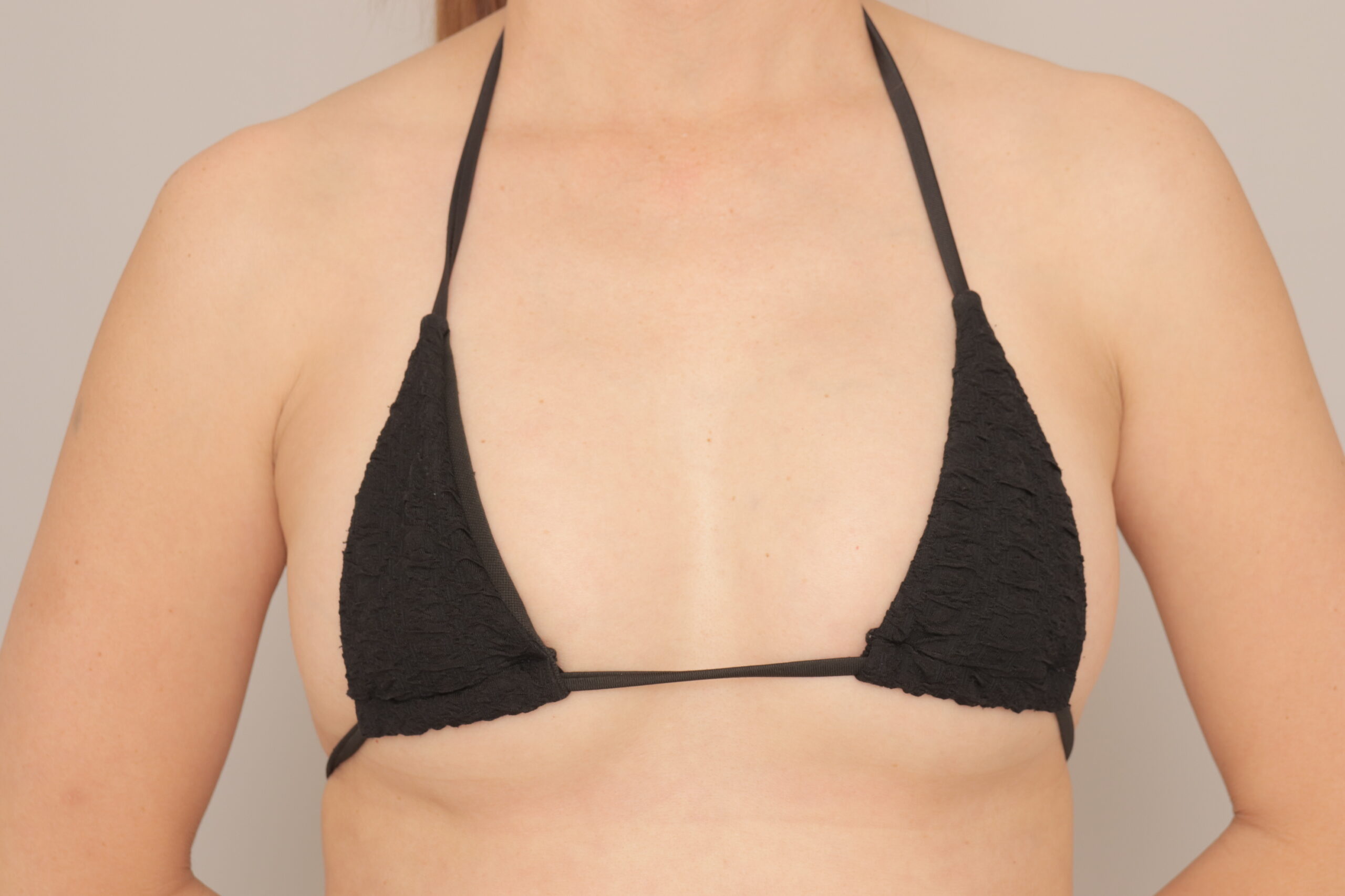 ベイザー脂肪吸引（1ヵ月経過：43）の術後写真