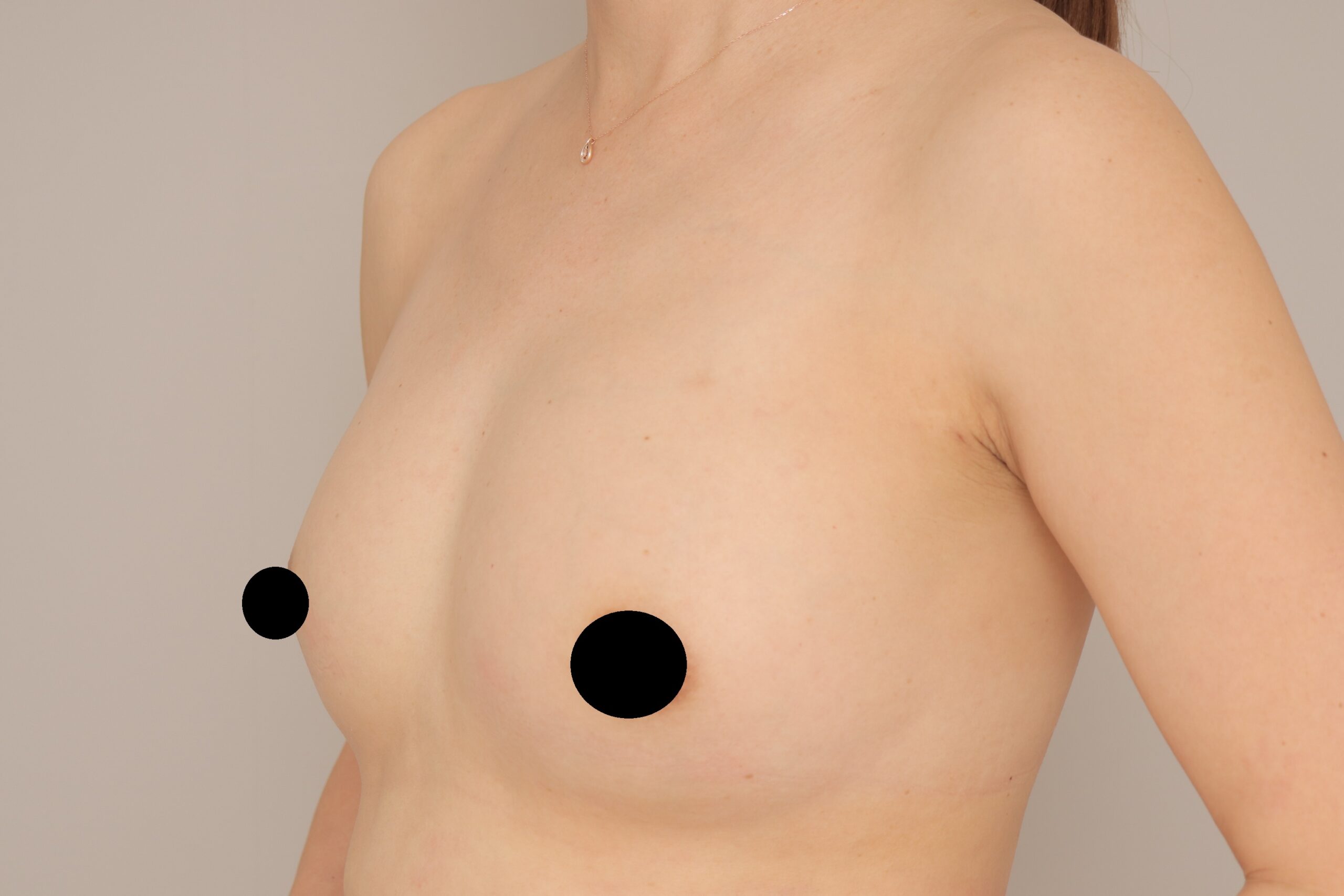 ベイザー脂肪吸引（3か月経過：43）の術後写真