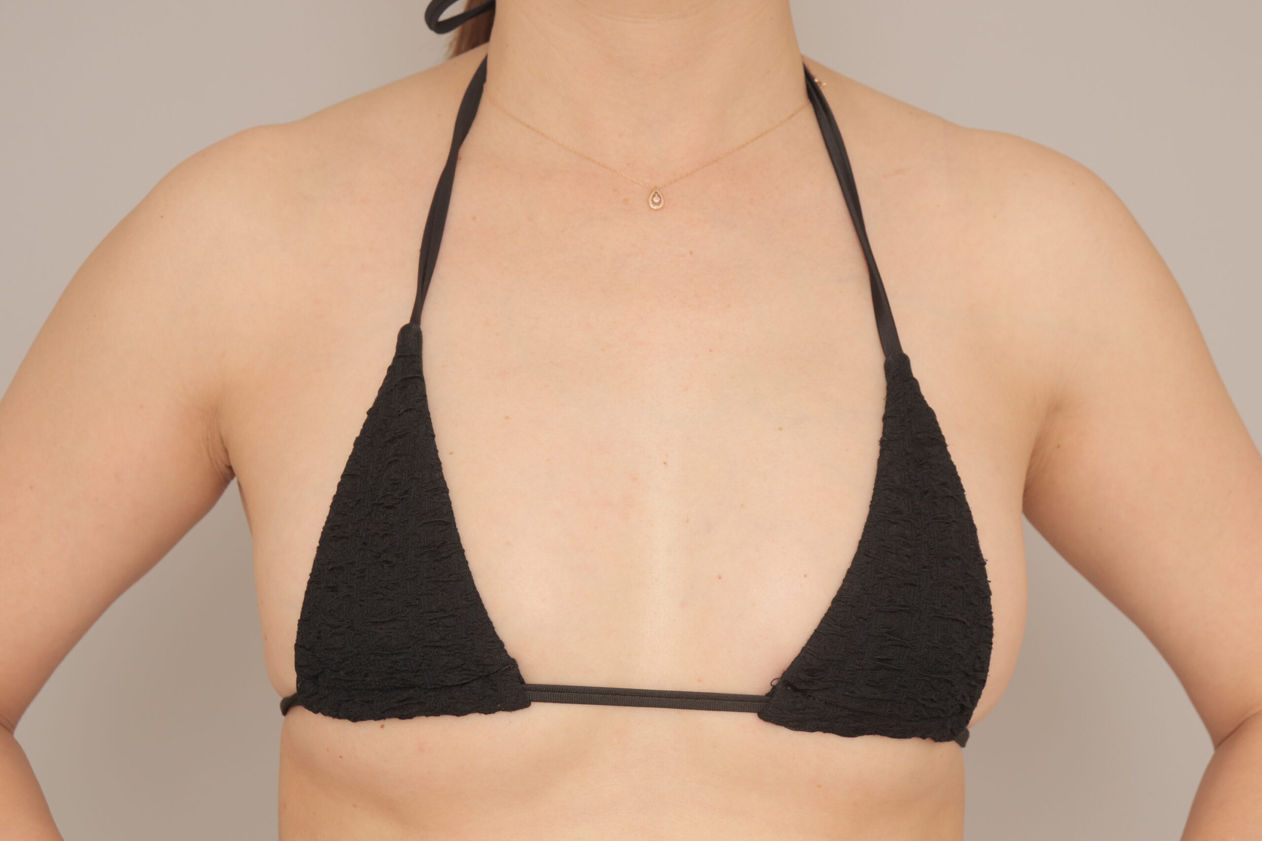 ベイザー脂肪吸引（3か月経過：43）の術後写真