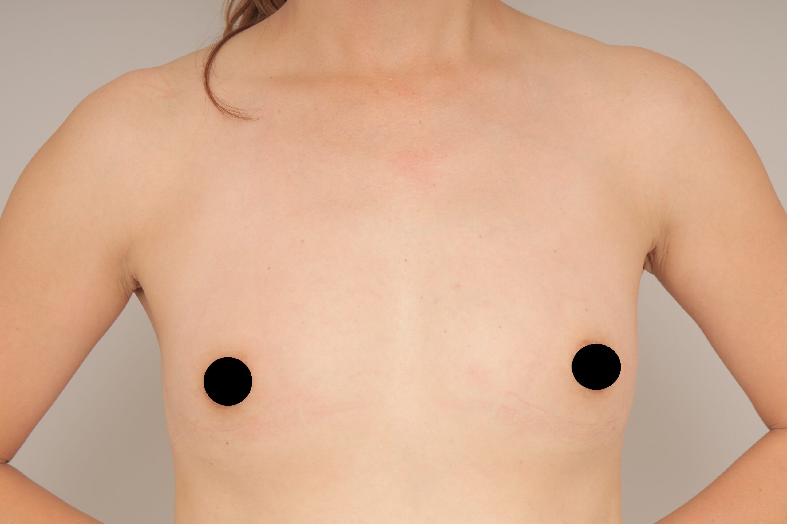 ベイザー脂肪吸引（1か月経過：43）の術前写真