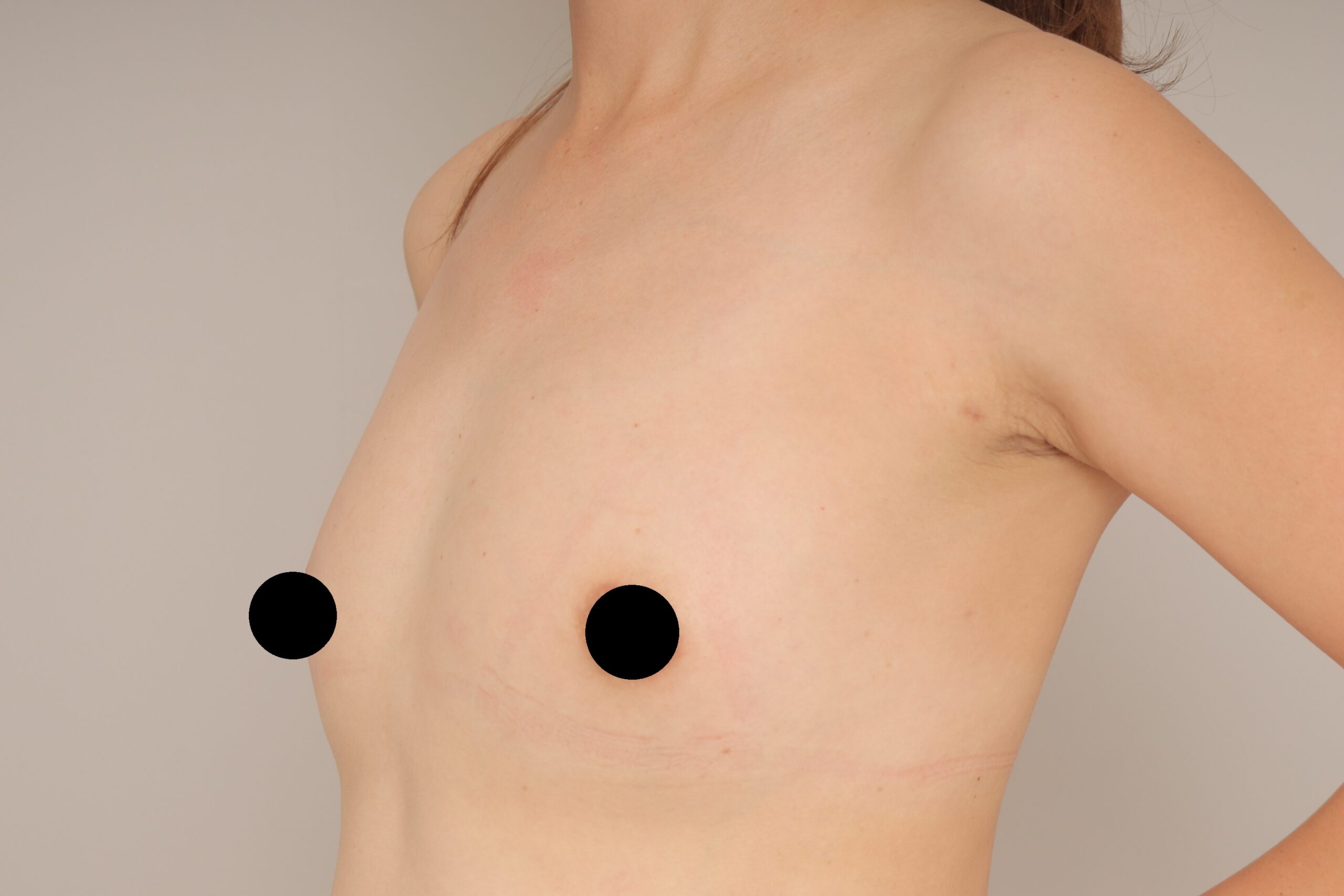 ベイザー脂肪吸引（3か月経過：43）の術前写真