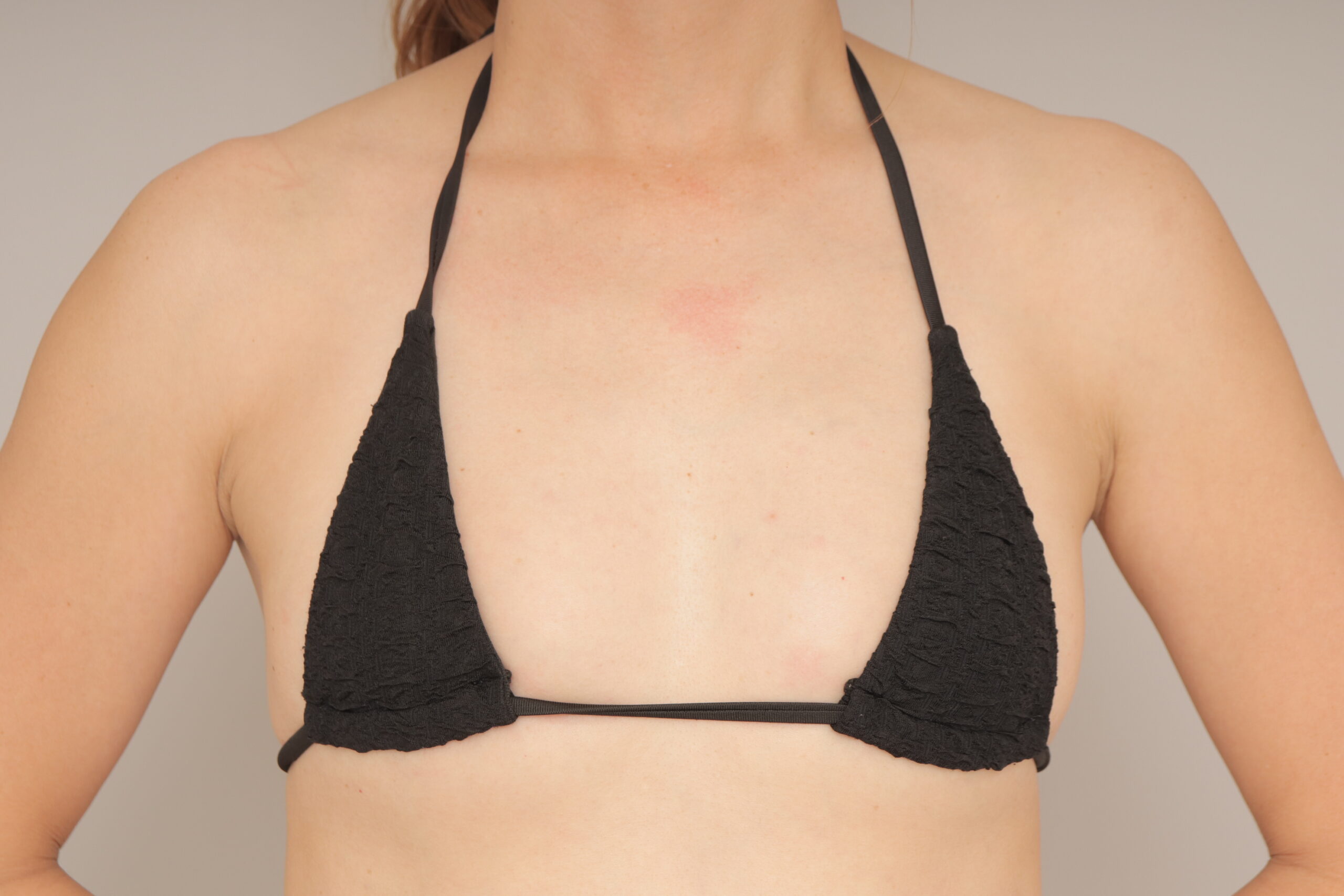 ベイザー脂肪吸引（1ヵ月経過：43）の術前写真