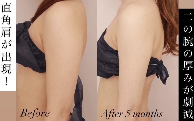 【「直角肩」が出現!】上半身のフレームがコンパクトに
