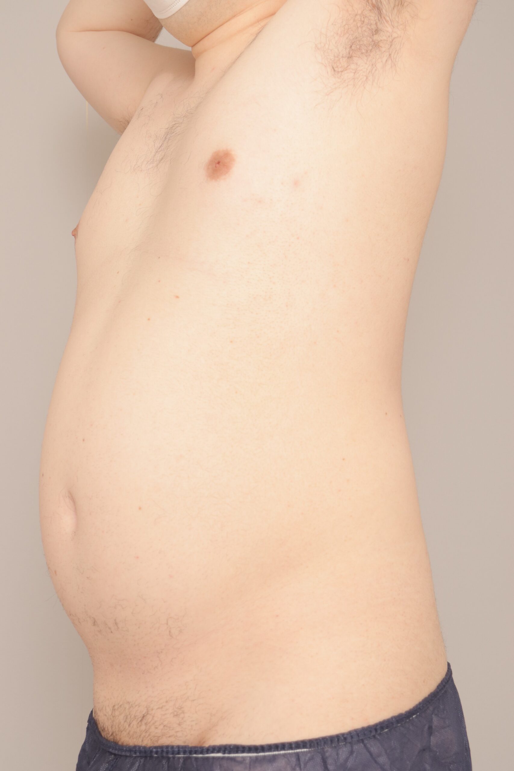 ベイザー脂肪吸引(3か月経過:45)の術前写真