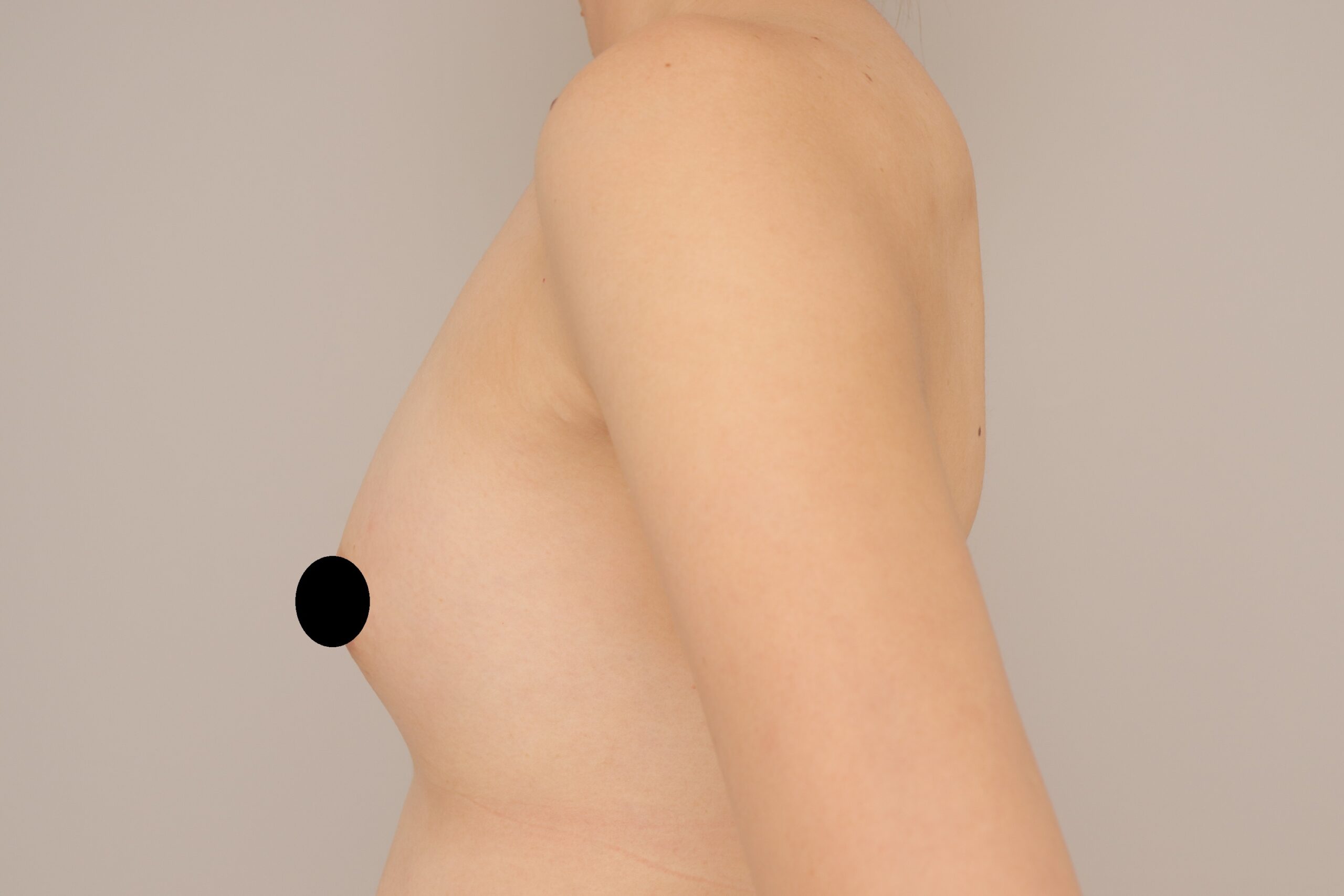 ベイザー脂肪吸引（1か月経過：29）の術後写真