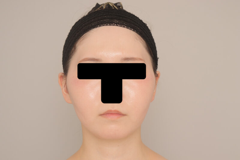 ベイザー脂肪吸引（６か月経過：27）の術後写真