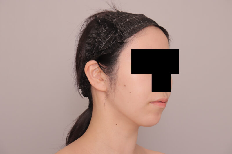 ベイザー脂肪吸引（3か月後経過：27）の術後写真