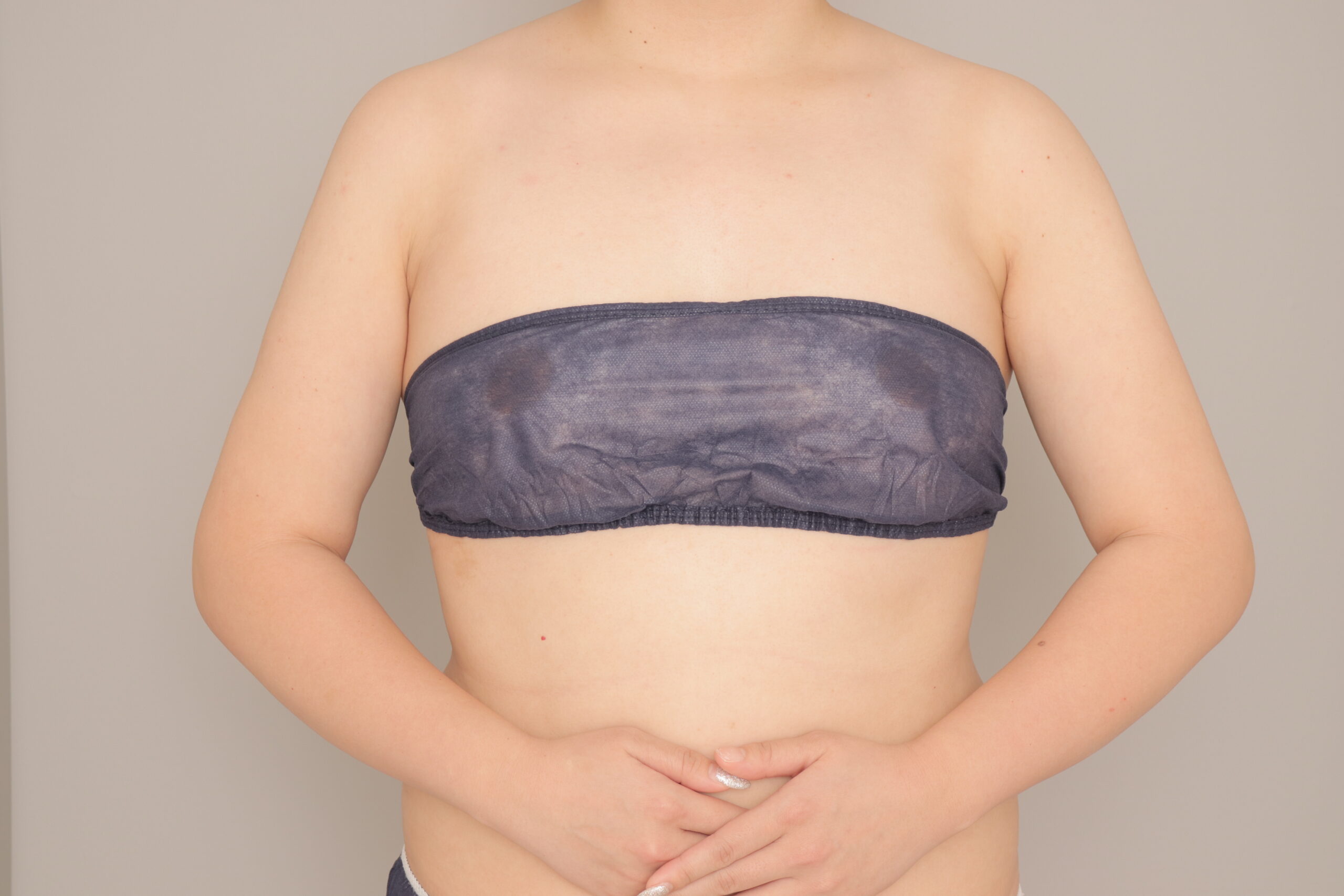 ベイザー脂肪吸引(6か月経過:25)の術後写真